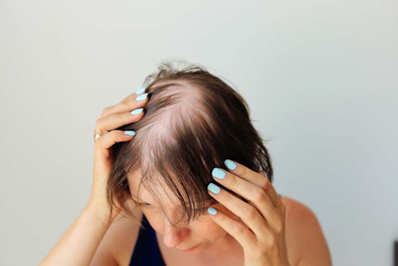 cấy tóc là phương pháp được khuyến cáo dành cho những người bị hói