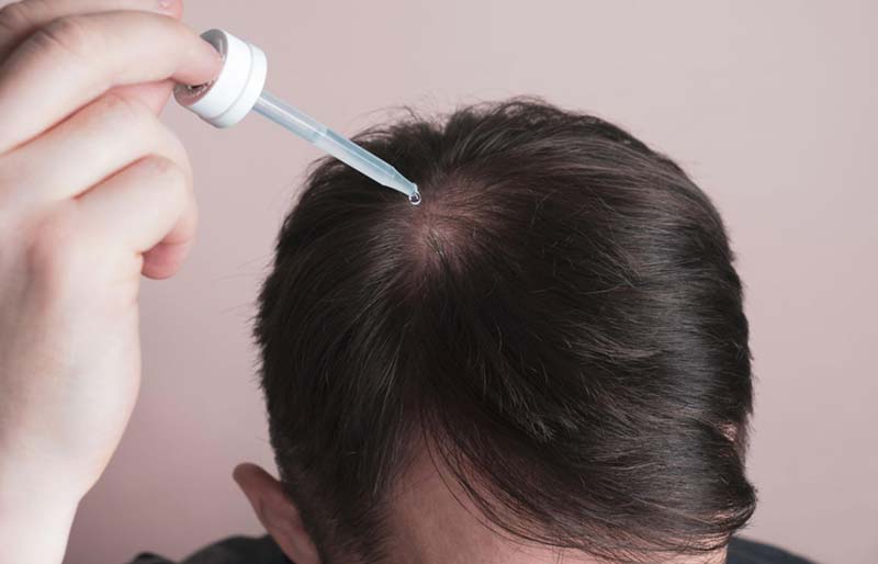 minoxidil loại thuốc dùng để điều trị rụng tóc