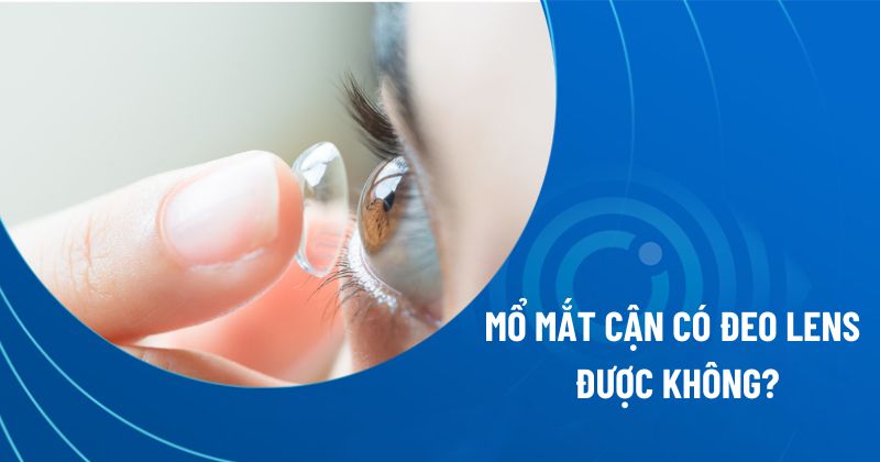 Mổ mắt cận có đeo lens được không?