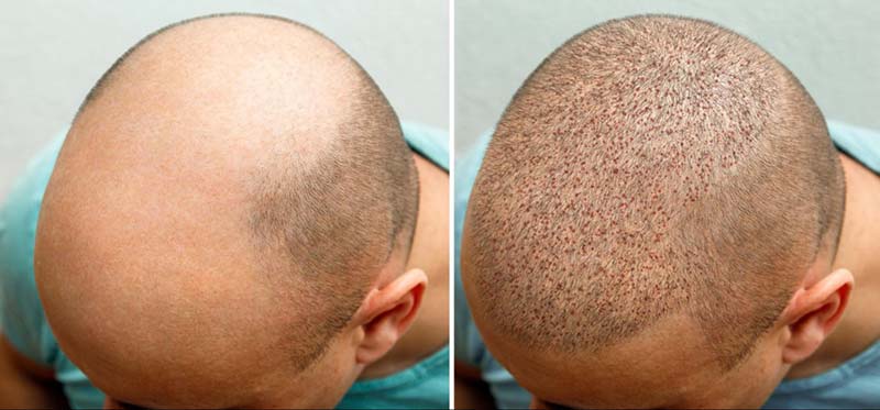 người đàn ông trước và sau khi cấy tóc