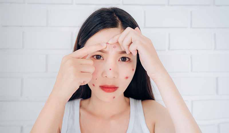 Rau má có tác dụng điều trị mụn Rau má có tác dụng điều trị mụn