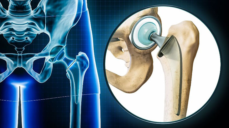 Thay khớp điều trị viêm khớp nhiễm khuẩn