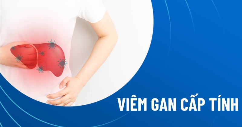 viêm gan cấp tính