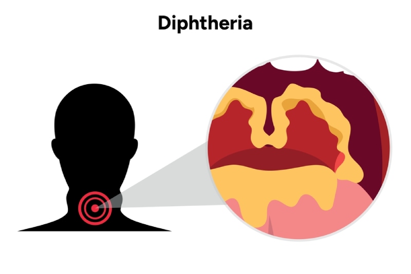 Bạch hầu thể họng thông thường