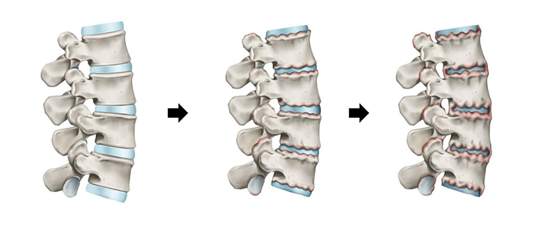 Bệnh lý viêm cột sống dính khớp