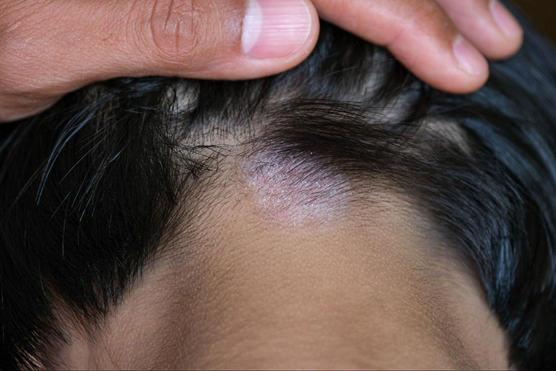 nấm da đầu