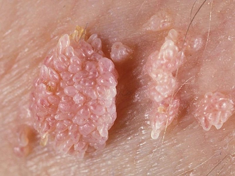 Nữ giới có thể bị mụn cóc khi quan hệ tình dục