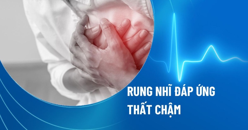 Rung nhĩ đáp ứng thất chậm: Nguyên nhân, triệu chứng và điều trị