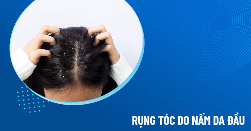 rụng tóc do nấm da đầu