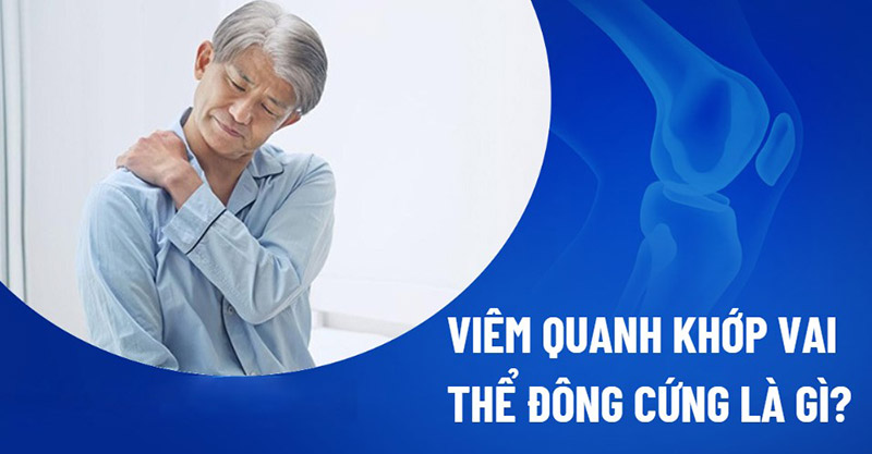 Viêm quanh khớp vai thể đông cứng