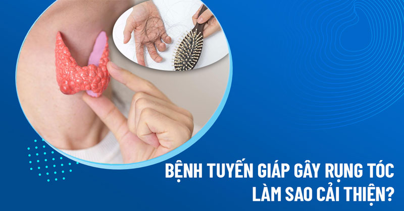 bệnh tuyến giáp gây rụng tóc