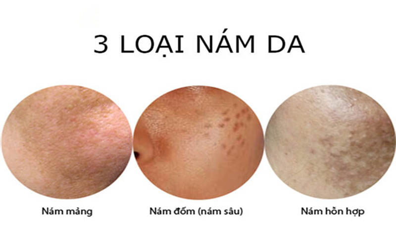 3 loại nám da mặt phổ biến