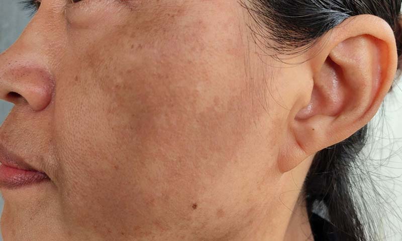 Cách nhận biết nám mảng và nám chân sâu