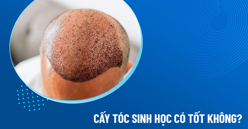 cấy tóc sinh học