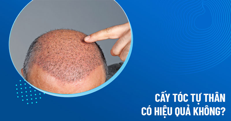 cấy tóc tự thân