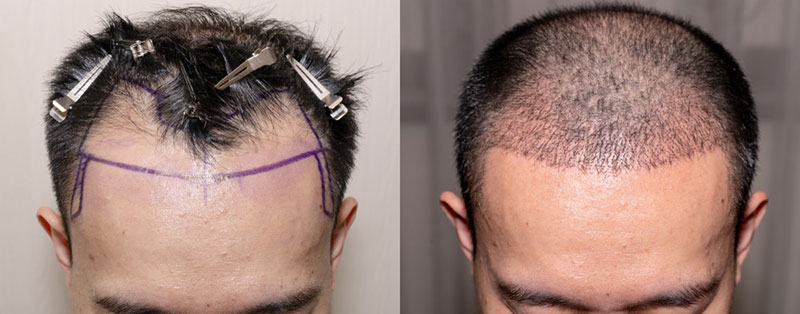 hình ảnh cấy tóc tự thân