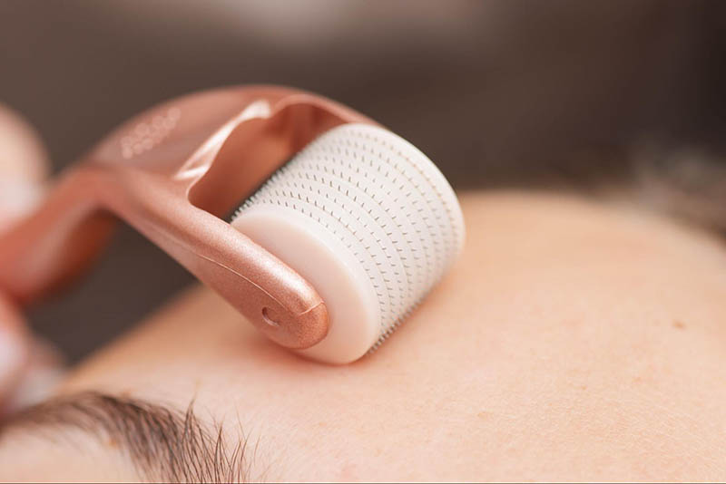 Lăn kim trị nám da hiệu quả tại nhà