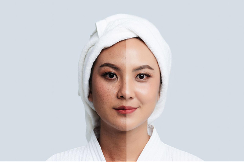 Liệu trình điều trị nám da