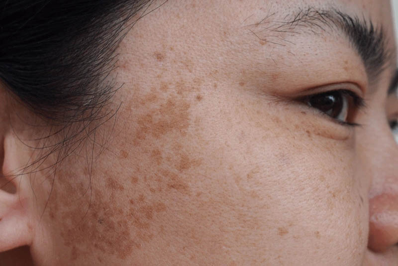 Nám hỗn hợp