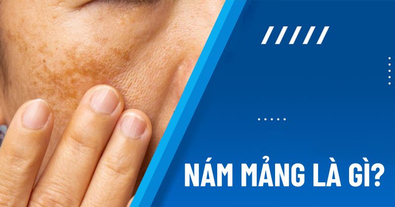 nám mảng là gì