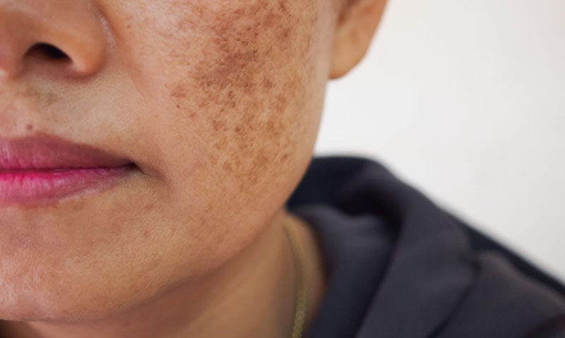 Nhận biết nám chân sâu và nám mảng