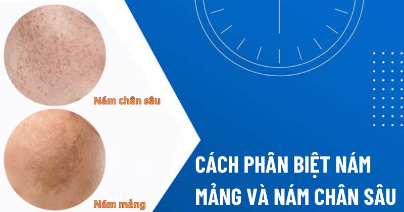 Phân biệt nám mảng và nám chân sâu