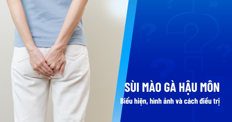 Sùi mào gà hậu môn