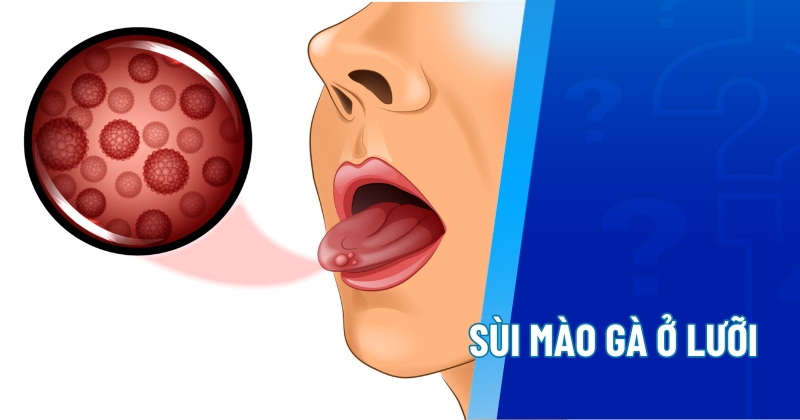 Sùi mào gà ở lưỡi