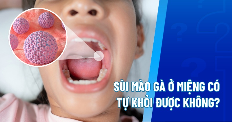 Sùi mào gà ở miệng có tự khỏi được không