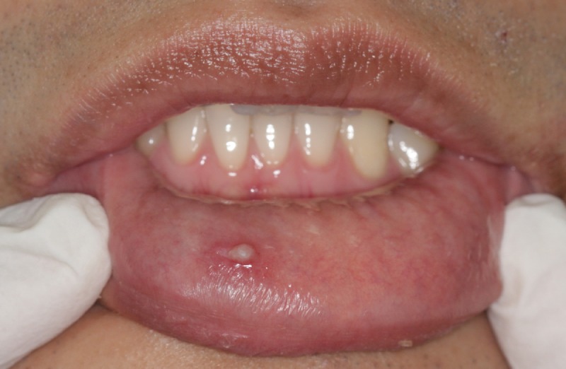 Sùi mào gà ở môi giai đoạn đầu