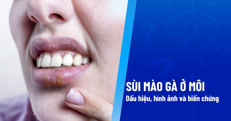 Sùi mào gà ở môi