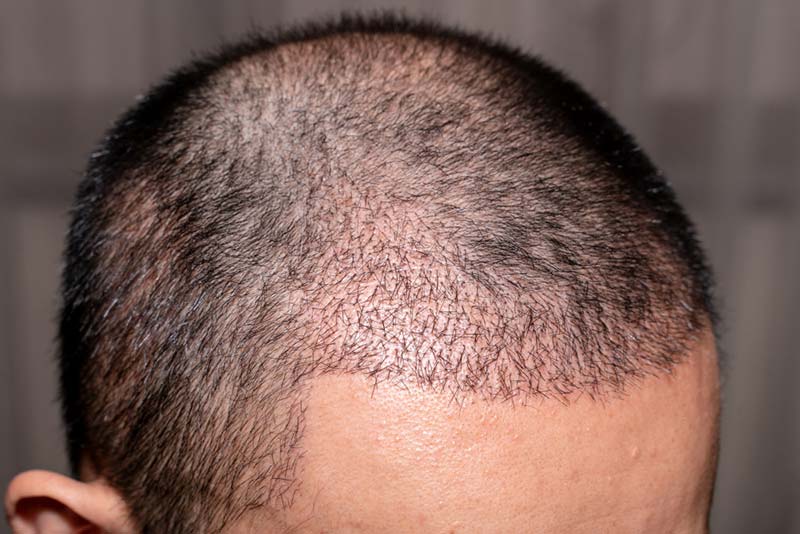 tóc mọc sau cấy tóc tự thân