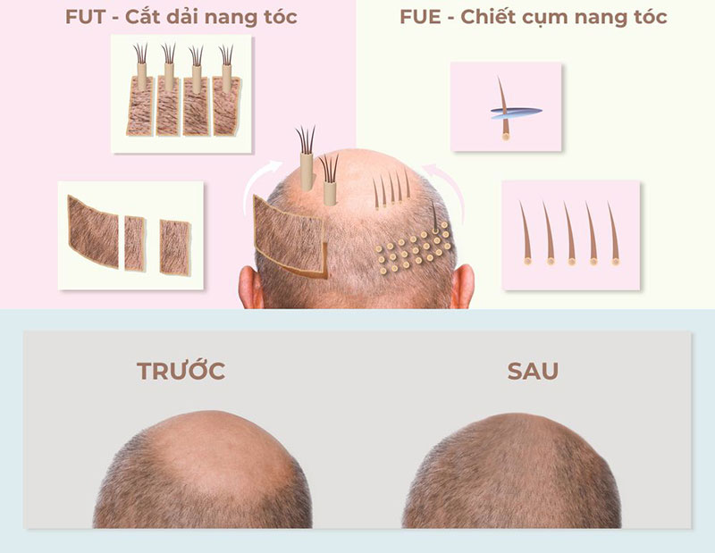 trước và sau thực hiện cấy tóc tự thân