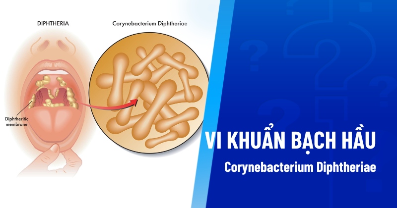 Vi khuẩn bạch hầu gram (Corynebacterium Diphtheriae) là gì? Đặc điểm