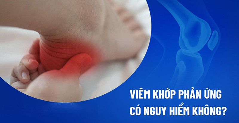 Viêm khớp phản ứng có nguy hiểm không