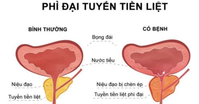 Bệnh phì đại tuyến tiền liệt lành tính