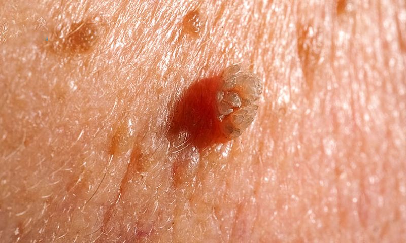 Điều trị sớm sùi mào gà