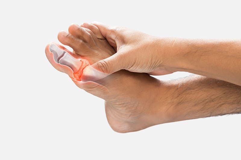 Gút ảnh hưởng đến sức khỏe sinh lý và sức khỏe tổng thể