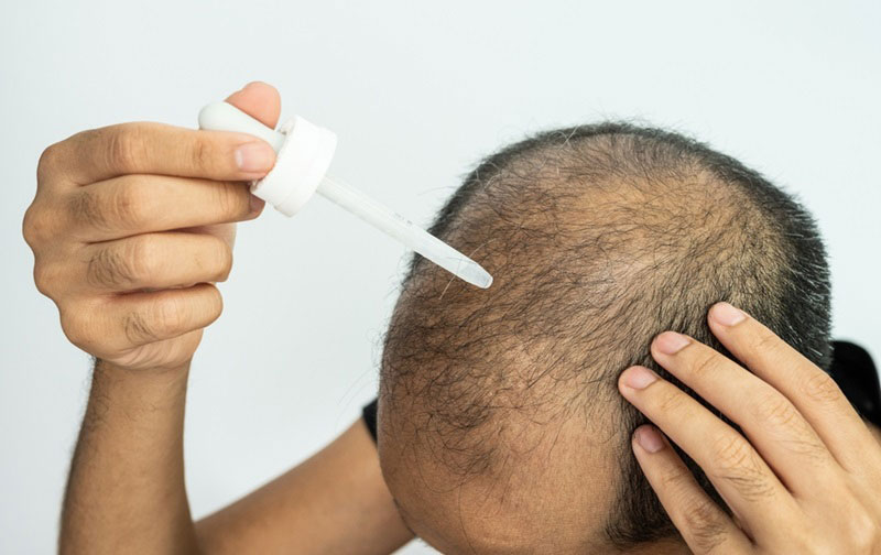 minoxidil điều trị rụng tóc