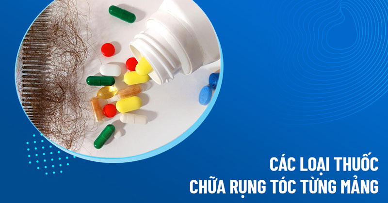 3 thuốc hỗ trợ chữa rụng tóc từng mảng: Phân tích mặt lợi và mặt hại