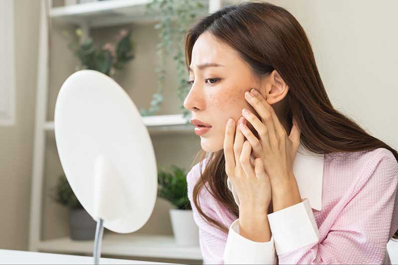 Tình trạng nám da