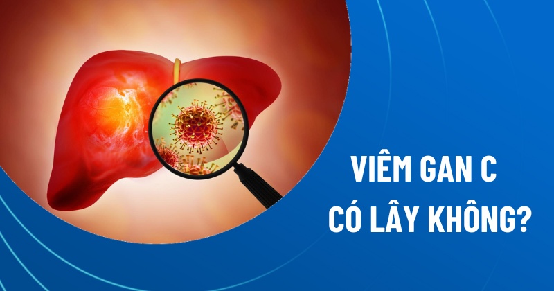viêm gan c có lây không