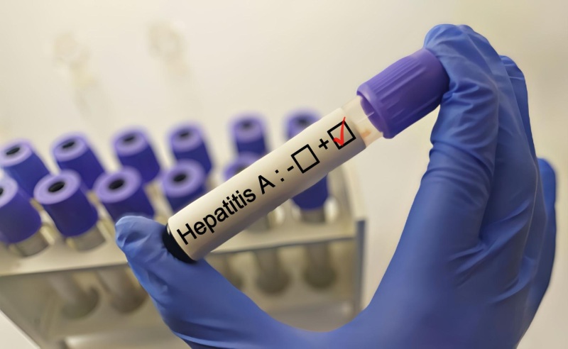 xét nghiệm virus viêm gan a