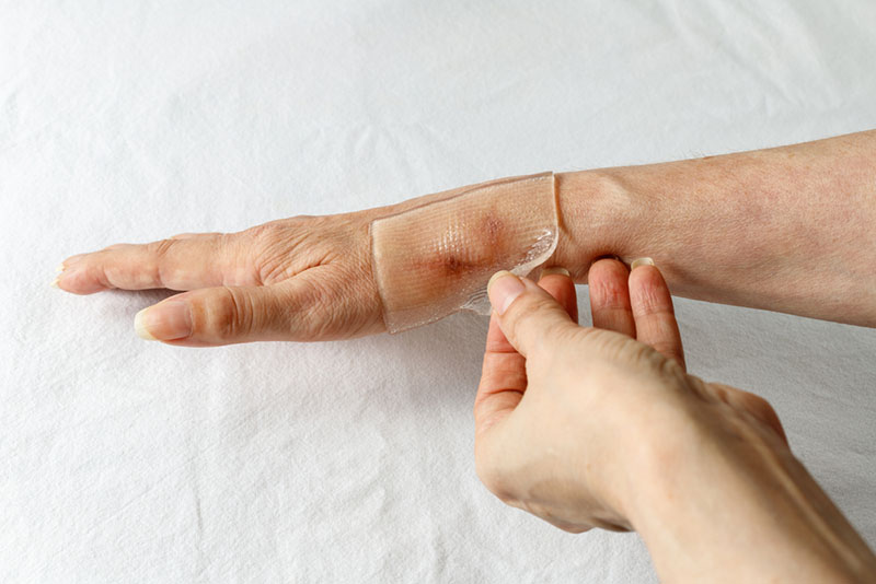 Bôi thuốc trị sẹo Contractubex 10g và băng vết sẹo bằng gạc thấm thuốc qua đêm đối với các loại sẹo cũ, cứng để tăng hiệu quả điều trị