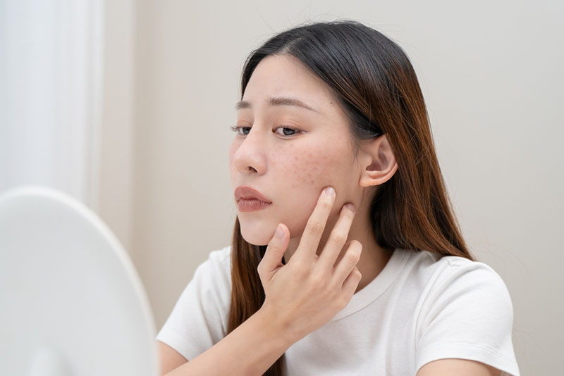 Cách ngăn ngừa thâm sau mụn