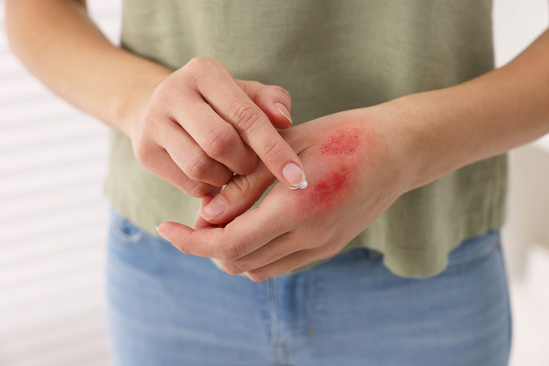 Kem trị sẹo Contractubex Đức review có thể điều trị nhiều loại sẹo khác nhau.