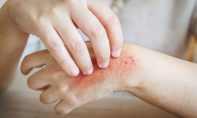 Ngứa, ban đỏ tại vùng da bị sẹo là tác dụng phụ thường gặp khi sử dụng kem bôi sẹo Contractubex