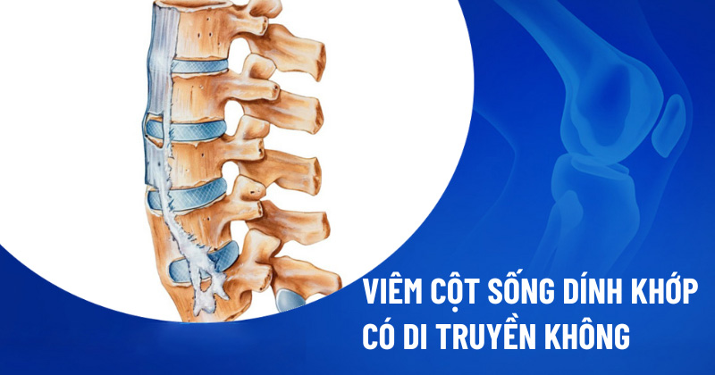Viêm cột sống dính khớp có di truyền không