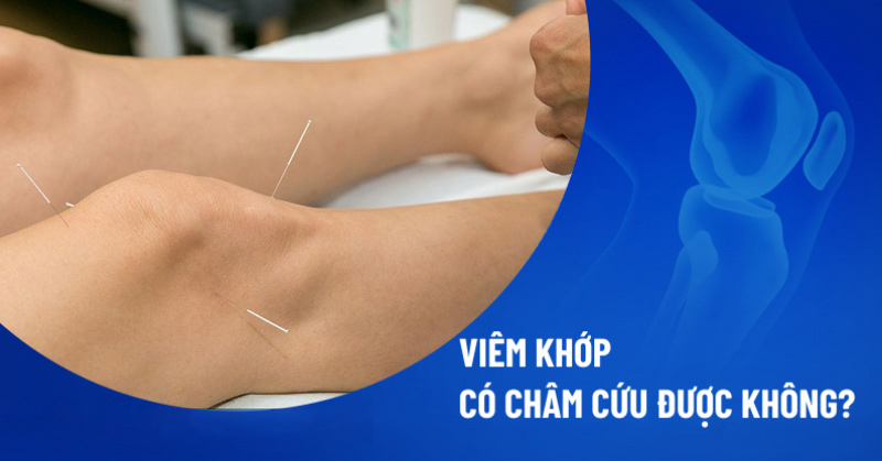 Viêm khớp có châm cứu được không