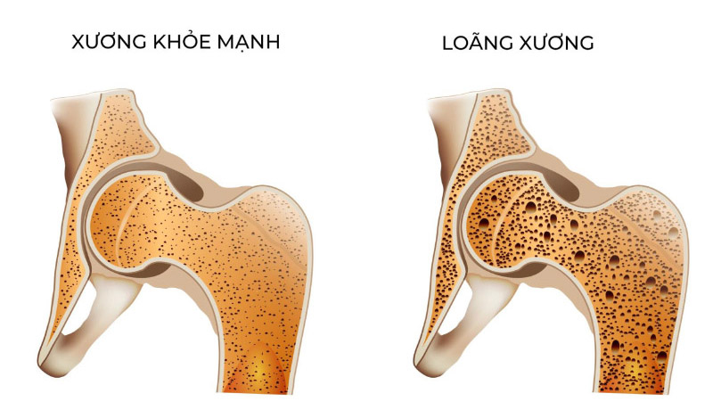 Loãng xương là nguyên nhân gây viêm khớp háng